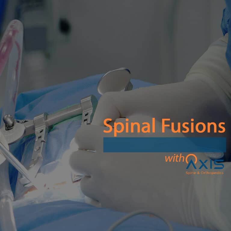 Spinal Fusions
