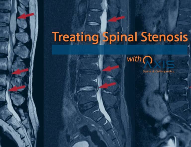 Treating Spinal Stenosis