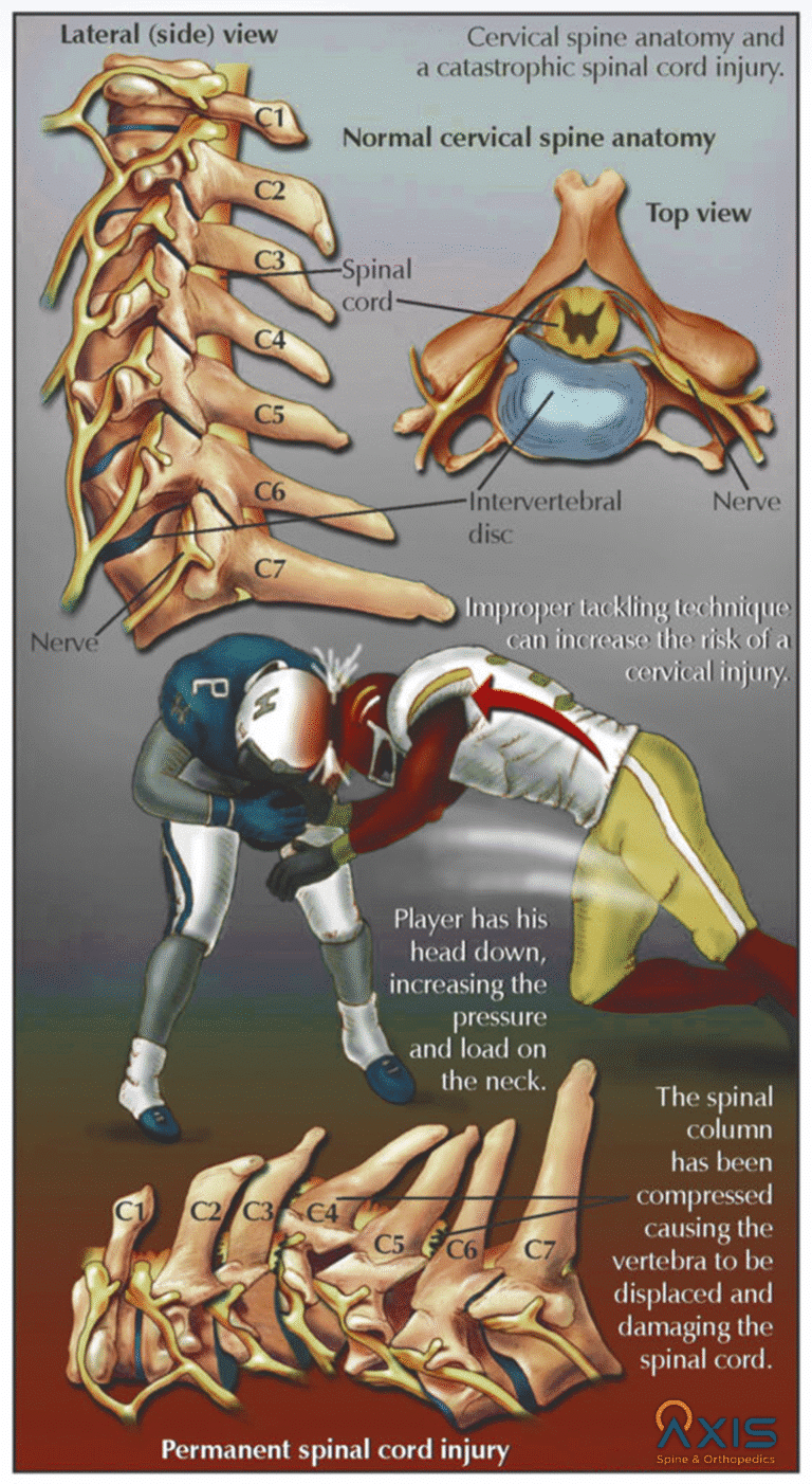 Football and the spine