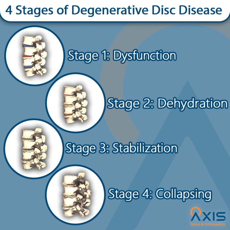 Degenerative Disc Disease