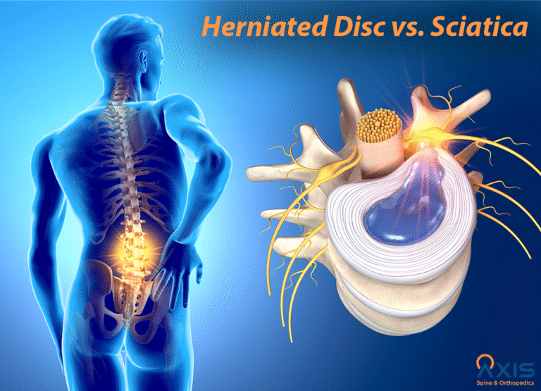 Herniated Disc vs sciatica